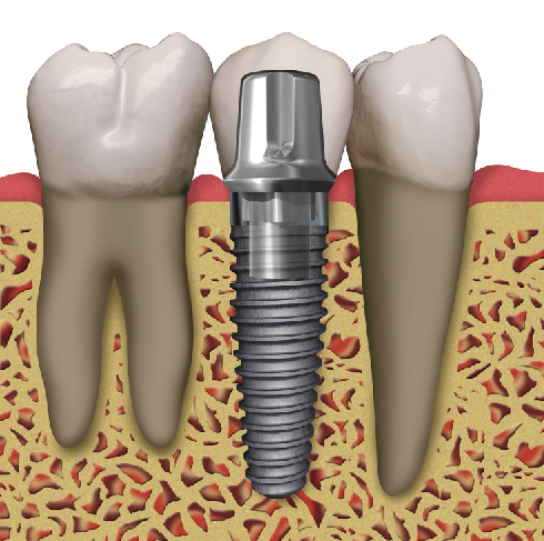Dental Implants | Dentist in Saluda, SC | Saluda Smilemakers